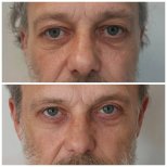 Résultats avant/après blépharoplastie supérieure et inférieure à la clinique Radzikowska