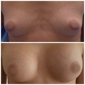 Before and after breast augmentation results at Radzikowska Plastic Surgery Clinic