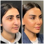 Before and after rhinoplasty result at Prof. Dr. Furkan Karabekmez Clinic Ankara, nose reshaping