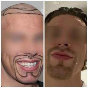Результати пересадки бороди та волосся FUE до і після в Medeks Hair Center для чоловіків