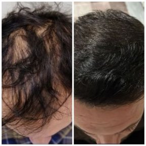 Результати до і після пересадки волосся FUE в Medeks Hair Center, відновлена густота