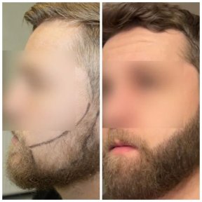 Before and after beard transplant results at Medeks Hair Center, fuller beard appearance