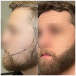 Before and after beard transplant results at Medeks Hair Center, fuller beard appearance