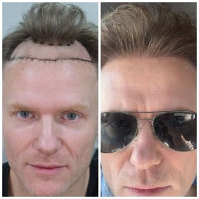 Результати пересадки волосся до і після в Medeks Hair Center, відновлена лінія волосся