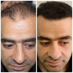 نتائج زراعة الشعر قبل وبعد في Medeks Hair Center – استعادة خط الشعر لدى المريض