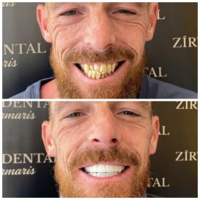 Before and after zirconia crown results at Marmaris Zirve Dental – smile transformation