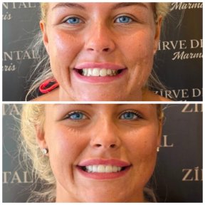 Before and after zirconia crown results at Marmaris Zirve Dental, smile makeover transformation