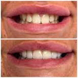 Before and after zirconia crown results at Marmaris Zirve Dental – improved smile aesthetics