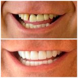 Before and after zirconia crown results at Marmaris Zirve Dental, improved smile aesthetics