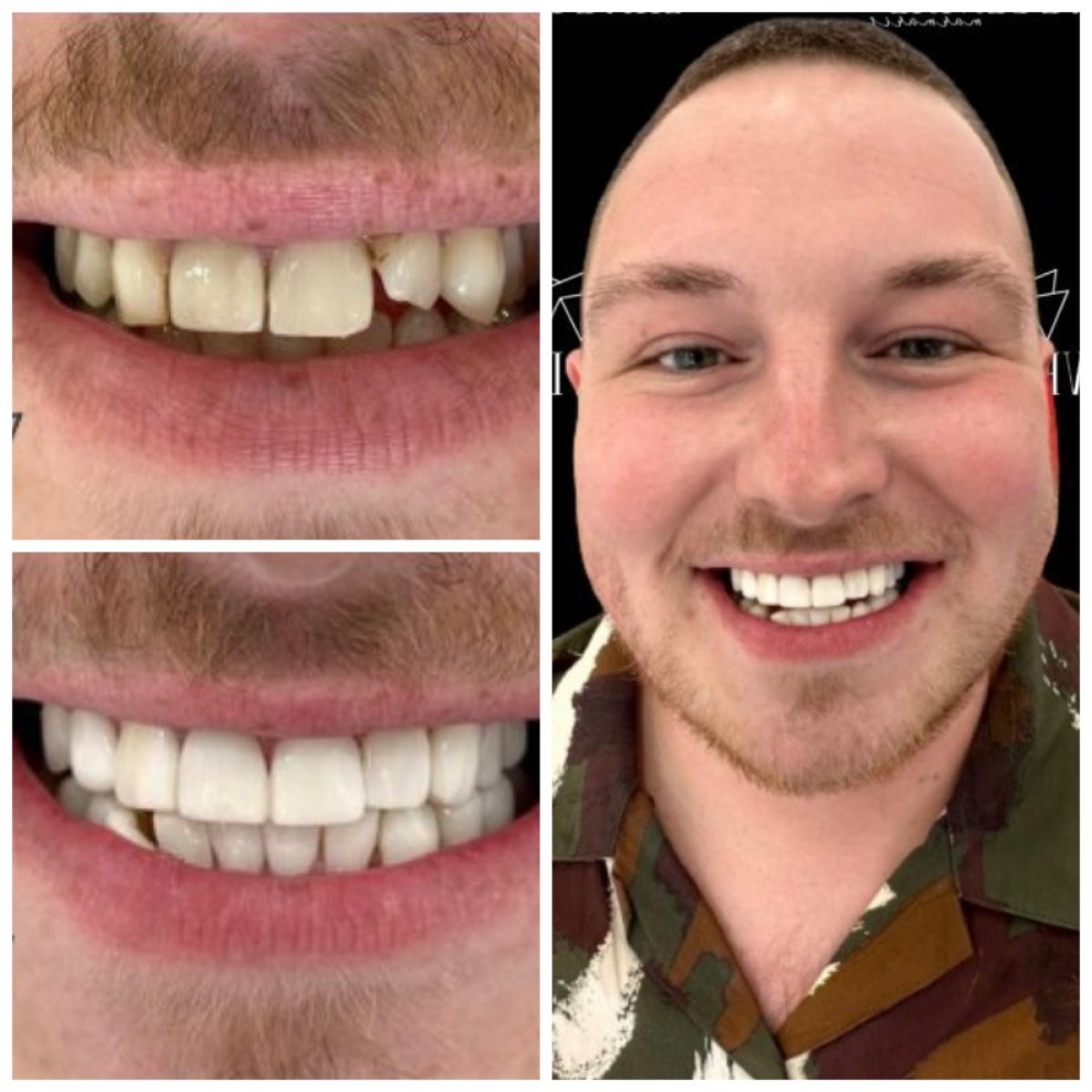 Resultados de bonding dental antes y después en Marmaris Zirve Dental – sonrisa mejorada