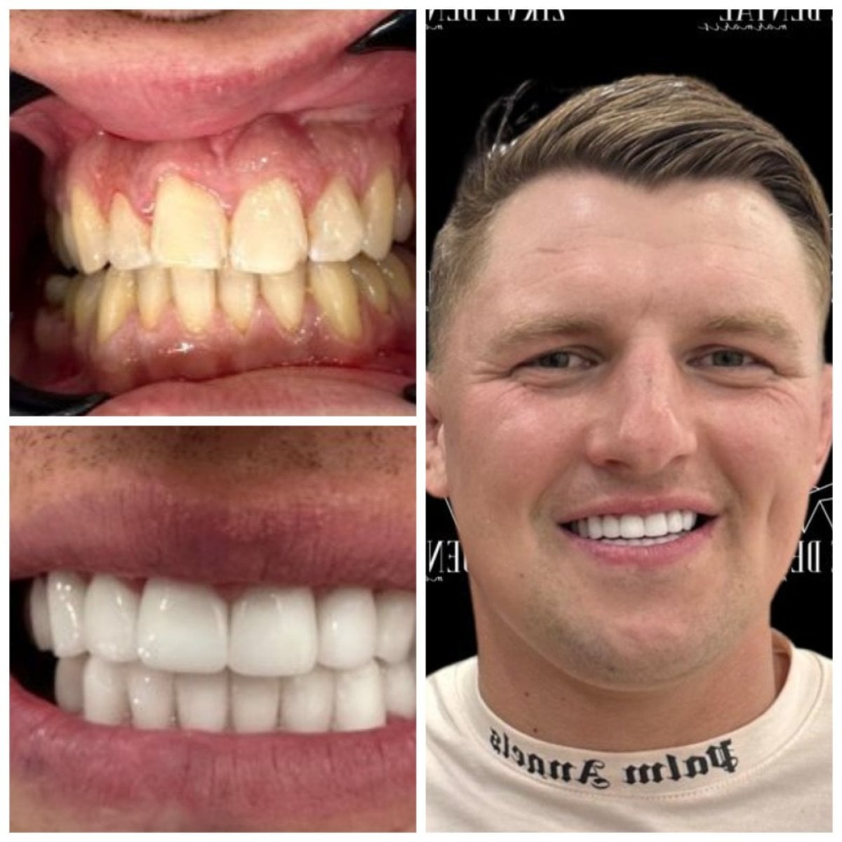 نتائج قبل وبعد عدسات الزركونيا في Marmaris Zirve Dental، تحول الابتسامة