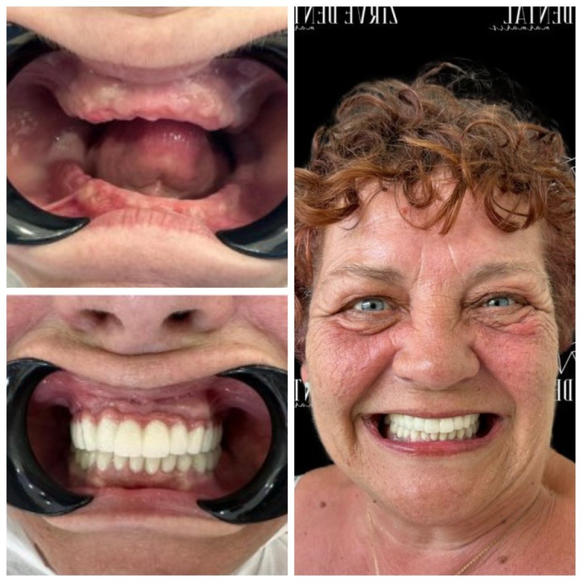 نتيجة قبل وبعد زراعة الأسنان All-on-6 في Marmaris Zirve Dental، ابتسامة مستعادة