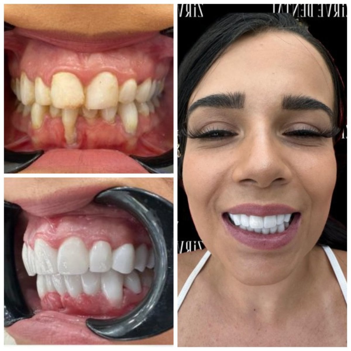 قبل وبعد فينير الزركونيا في Marmaris Zirve Dental – نتائج تجميل الابتسامة