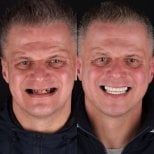Before and after All-on-6 dental implants result at RIKOTA Dental Clinic, full smile restoration