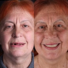 Before and after All-on-6 dental implants result at RIKOTA Dental Clinic, restored smile