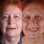 Before and after All-on-6 dental implants result at RIKOTA Dental Clinic, restored smile