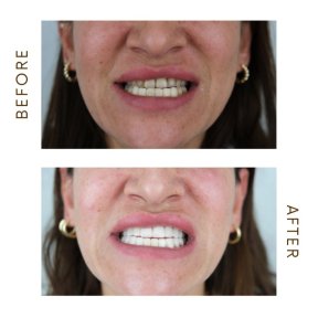 before-after photo hollywood-smile