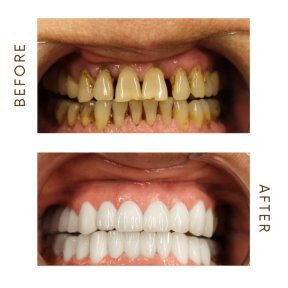 before-after photo hollywood-smile