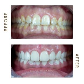 before-after photo hollywood-smile