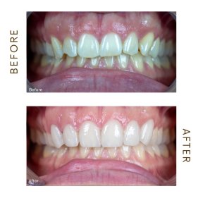 before-after photo hollywood-smile