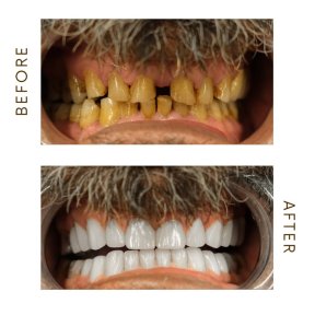 before-after photo hollywood-smile