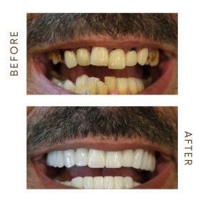before-after photo hollywood-smile