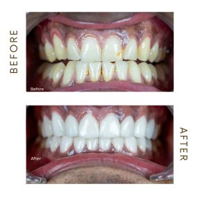 before-after photo hollywood-smile