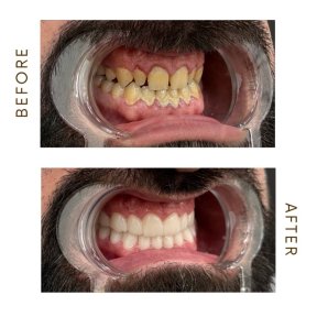before-after photo hollywood-smile