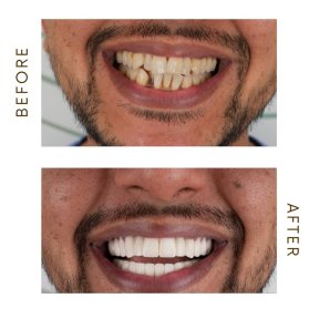 before-after photo hollywood-smile