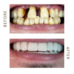before-after photo hollywood-smile