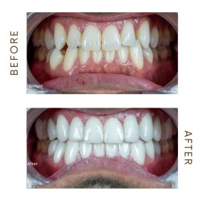 before-after photo hollywood-smile