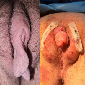 before-after photo sex-reassignment-surgery