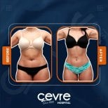 Efekty liposukcji brzucha przed i po w Adem and Havva Medical Center, szczuplejsza talia