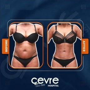Efekty liposukcji brzucha przed i po w Adem and Havva Medical Center, modelowanie sylwetki
