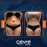 Efekty liposukcji brzucha przed i po w Adem and Havva Medical Center, szczuplejsza talia