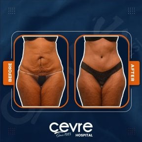 Efekty liposukcji brzucha przed i po w Adem and Havva Medical Center, modelowanie sylwetki