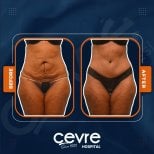 Efekty liposukcji brzucha przed i po w Adem and Havva Medical Center, modelowanie sylwetki