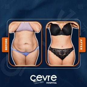 Efekty liposukcji brzucha przed i po w Adem and Havva Medical Center, modelowanie sylwetki