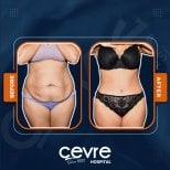 Efekty liposukcji brzucha przed i po w Adem and Havva Medical Center, modelowanie sylwetki