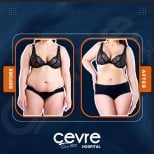 Efekty liposukcji brzucha przed i po w Adem and Havva Medical Center, modelowanie sylwetki