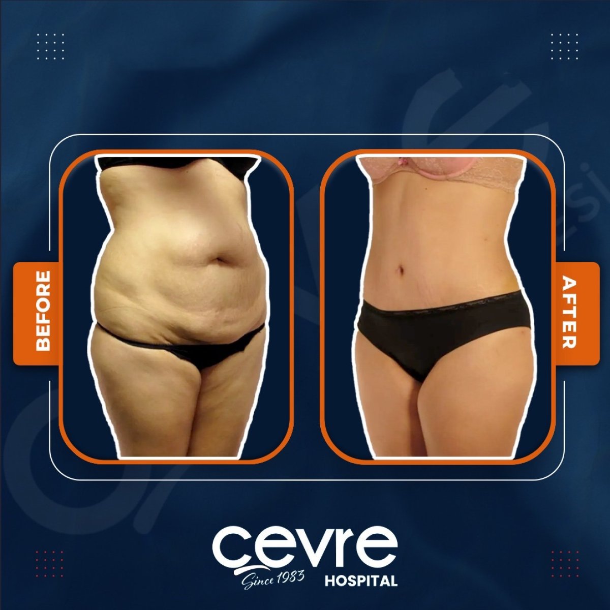 Resultados de liposucción abdominal antes y después en Adem and Havva Medical Center, cintura más delgada