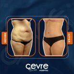 Efekty liposukcji brzucha przed i po w Adem and Havva Medical Center, szczuplejsza talia