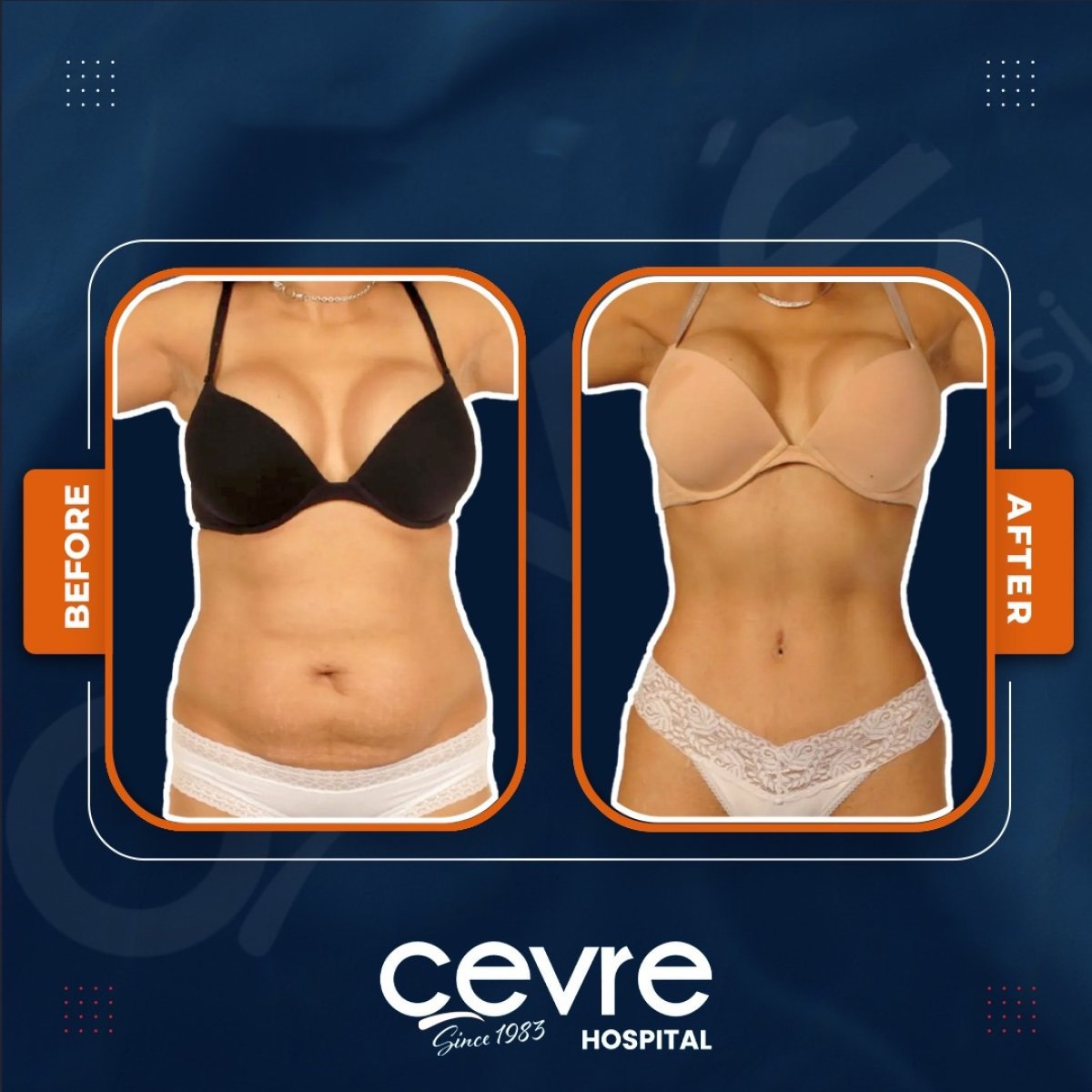 نتائج شفط دهون البطن قبل وبعد في Adem and Havva Medical Center، خصر أنحف