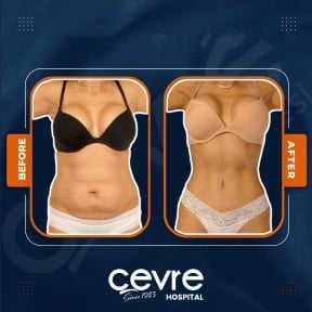 Efekty liposukcji brzucha przed i po w Adem and Havva Medical Center, szczuplejsza talia