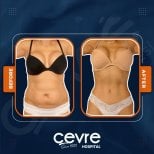 Efekty liposukcji brzucha przed i po w Adem and Havva Medical Center, szczuplejsza talia