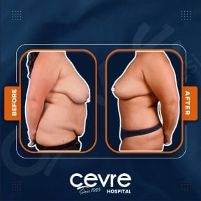 Efekty liposukcji brzucha przed i po w Adem and Havva Medical Center, modelowanie sylwetki