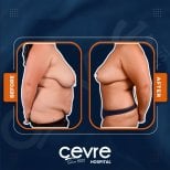 Efekty liposukcji brzucha przed i po w Adem and Havva Medical Center, modelowanie sylwetki