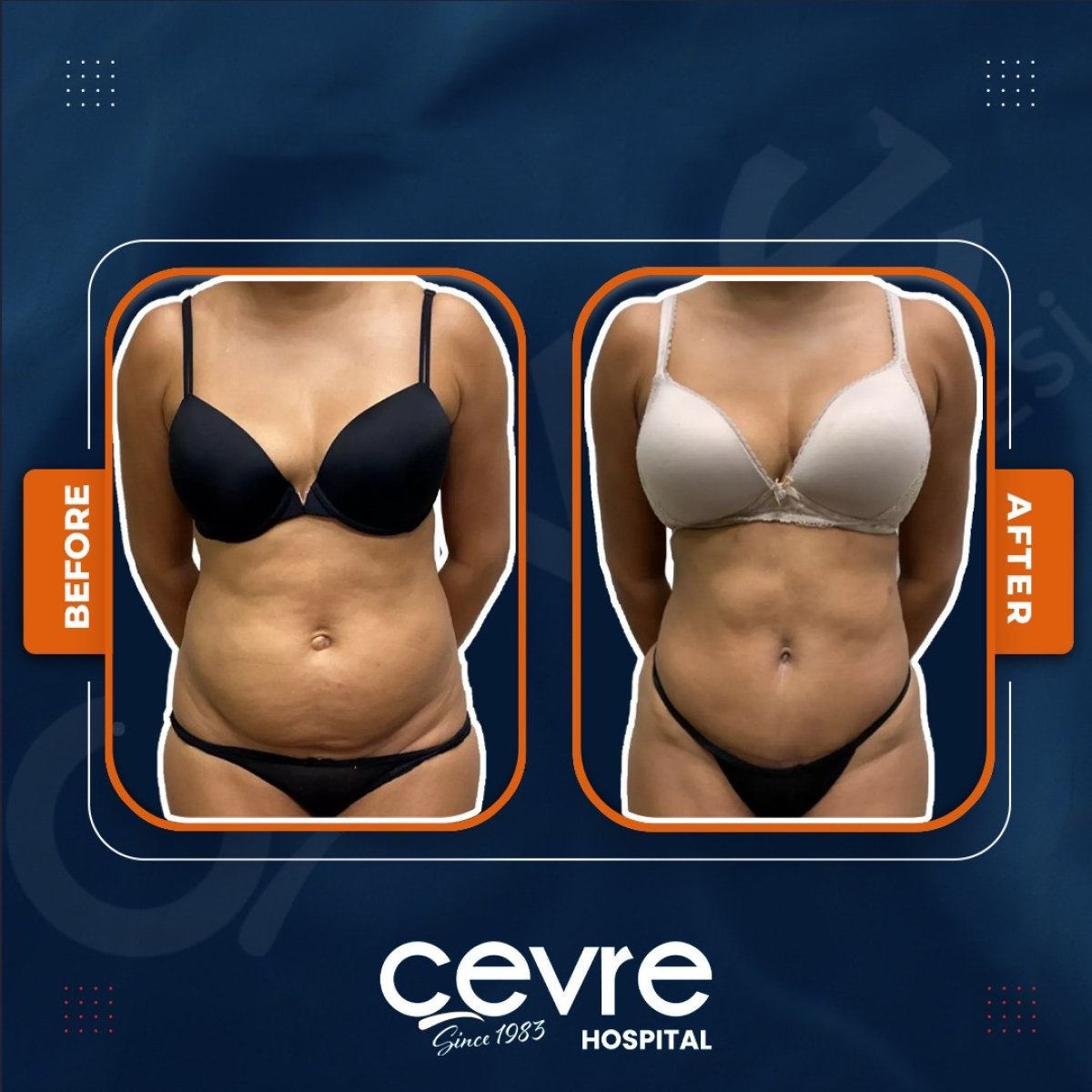 Resultados de liposucción abdominal antes y después en Adem and Havva Medical Center, cintura más delgada