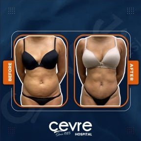 Efekty liposukcji brzucha przed i po w Adem and Havva Medical Center, szczuplejsza talia