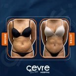 Efekty liposukcji brzucha przed i po w Adem and Havva Medical Center, szczuplejsza talia